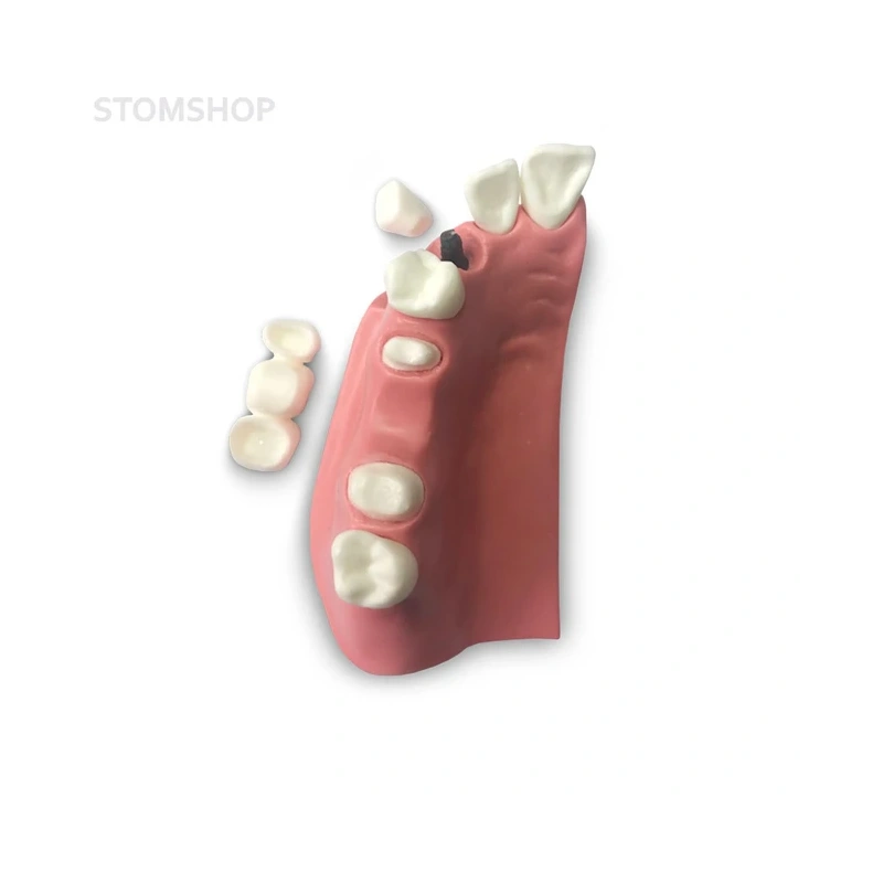 DM23 – модель верхней челюсти для демонстрации установки зубного моста | GF Dental (Италия)