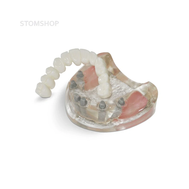 T10 – демонстрационная модель верхней челюсти с 6 имплантами и протезом | GF Dental (Италия)