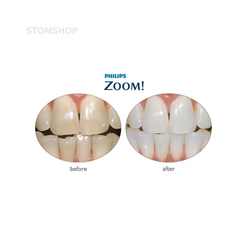 Philips Zoom! Chairside Double Kit - двойной набор для отбеливания с улучшенным гелем (для 2-х пациентов) | Philips (Нидерланды)