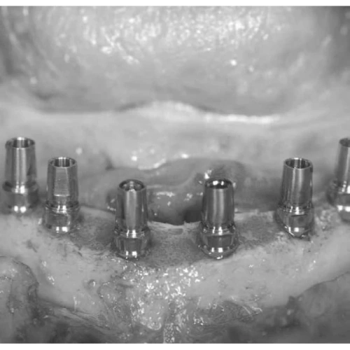 LM Implant Misura MR 3.3-5.6 - инструмент для позиционирования имплантатов | LM-Instruments Oy (Финляндия)