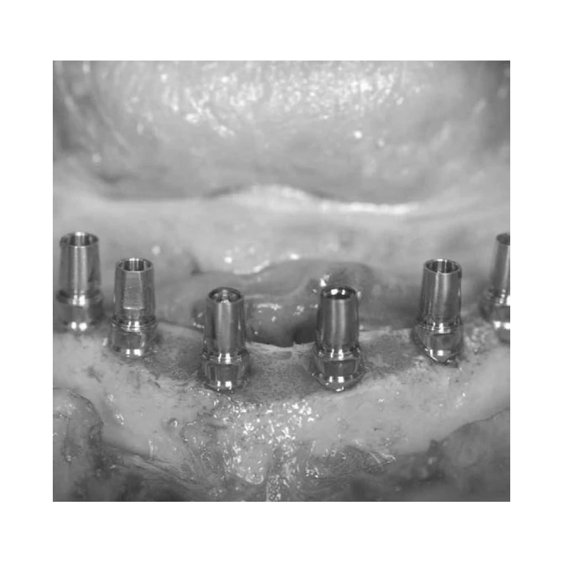 LM Implant Misura MR 3.3-5.6 - инструмент для позиционирования имплантатов | LM-Instruments Oy (Финляндия)