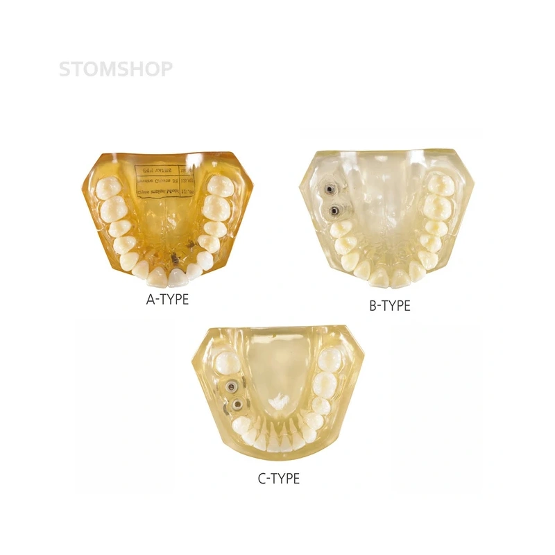CRYSTAL IMPLANT MODEL - модель для демонстрации установки имплантатов | Hanil (Ю. Корея)