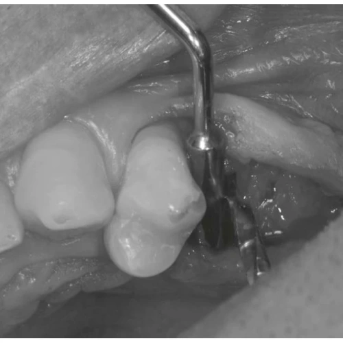 LM Implant Misura MR 3.4-5.8 - инструмент для позиционирования имплантатов | LM-Instruments Oy (Финляндия)