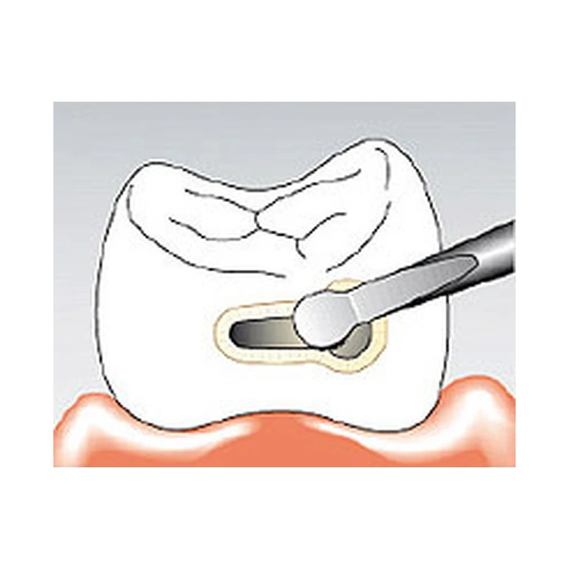 Sonicflex bevel №59 - насадка для минимально инвазивной терапии кариеса с алмазным покрытием, дистальная | KaVo (Германия)