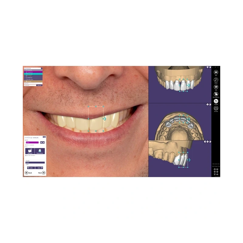 Exocad Smile Creator - модуль для планирования улыбки | Exocad (Германия)