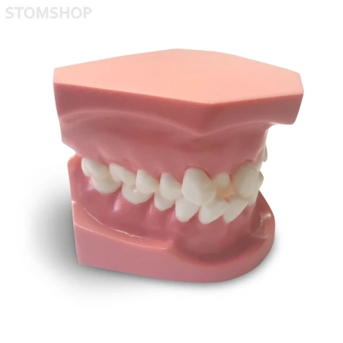 ORB02 – ортодонтическая модель с брекетами и твердой десной, 1 класс | GF Dental (Италия)