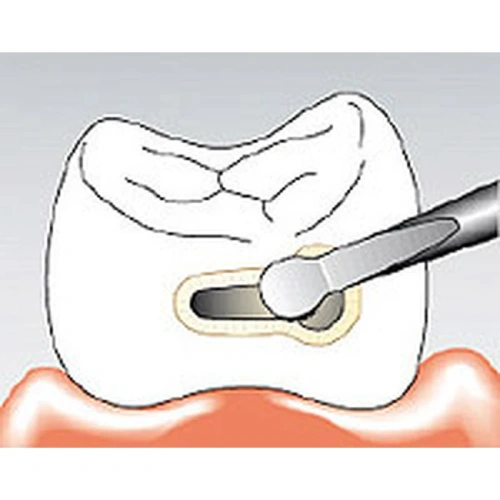 Sonicflex micro №31 A - насадка для минимально инвазивной терапии кариеса с алмазным покрытием, малая полусфера, дистальная | KaVo (Германия)