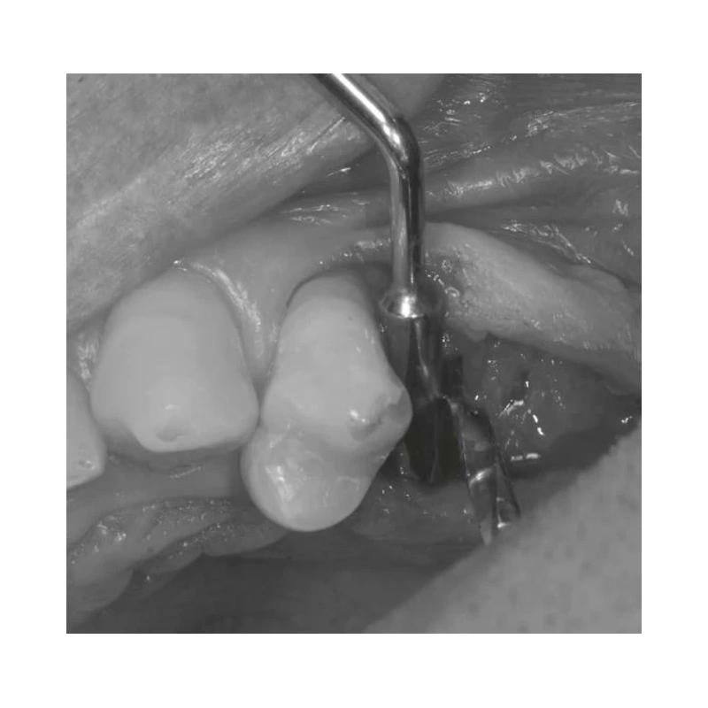 LM Implant Misura MR 3.3-5.6 - инструмент для позиционирования имплантатов | LM-Instruments Oy (Финляндия)